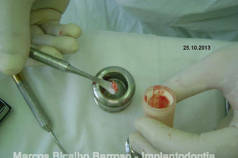 Regeneração Óssea Guiada com Osso Autógeno + Xenógeno + Tela de Titânio