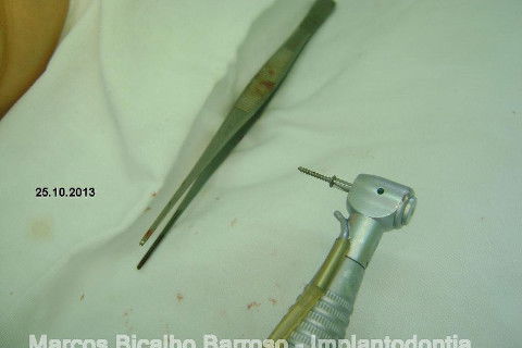 Regeneração Óssea Guiada com Osso Autógeno + Xenógeno + Tela de Titânio