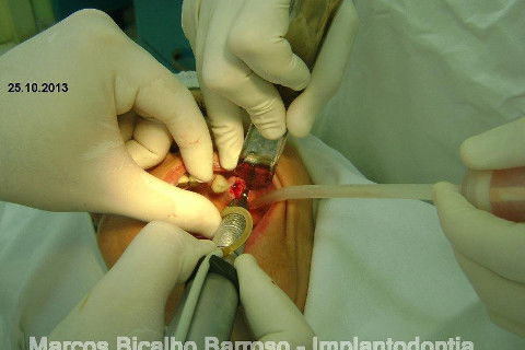 Regeneração Óssea Guiada com Osso Autógeno + Xenógeno + Tela de Titânio