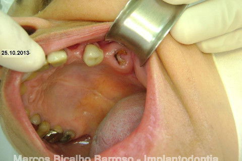 Regeneração Óssea Guiada com Osso Autógeno + Xenógeno + Tela de Titânio