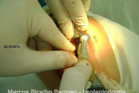 Regeneração Óssea Guiada com Osso Autógeno + Xenógeno + Tela de Titânio