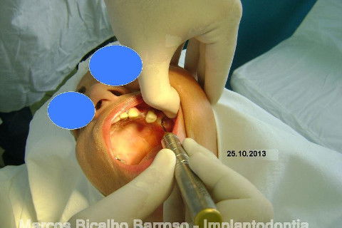 Regeneração Óssea Guiada com Osso Autógeno + Xenógeno + Tela de Titânio