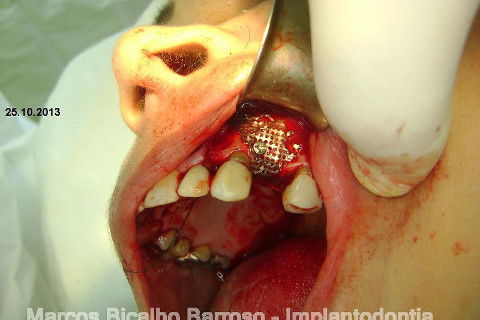 Regeneração Óssea Guiada com Osso Autógeno + Xenógeno + Tela de Titânio