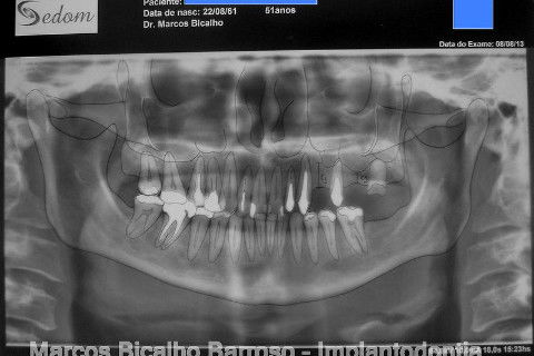 Regeneração Óssea Guiada com Osso Autógeno + Xenógeno + Tela de Titânio