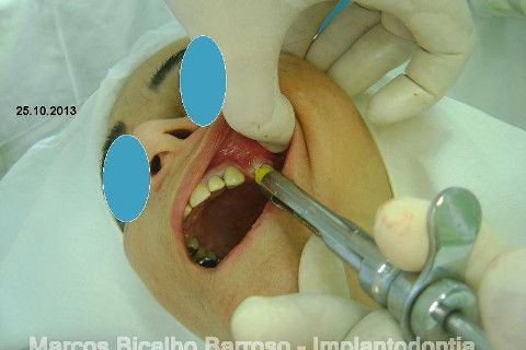 Regeneração Óssea Guiada com Osso Autógeno + Xenógeno + Tela de Titânio