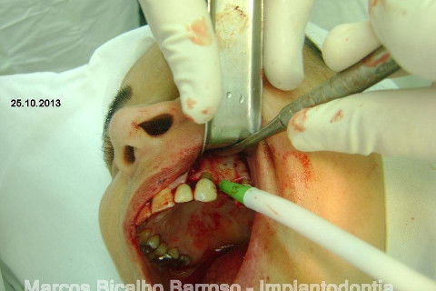 Regeneração Óssea Guiada com Osso Autógeno + Xenógeno + Tela de Titânio