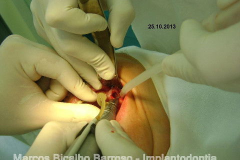 Regeneração Óssea Guiada com Osso Autógeno + Xenógeno + Tela de Titânio