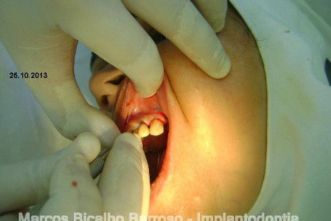 Regeneração Óssea Guiada com Osso Autógeno + Xenógeno + Tela de Titânio