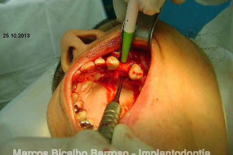 Regeneração Óssea Guiada com Osso Autógeno + Xenógeno + Tela de Titânio