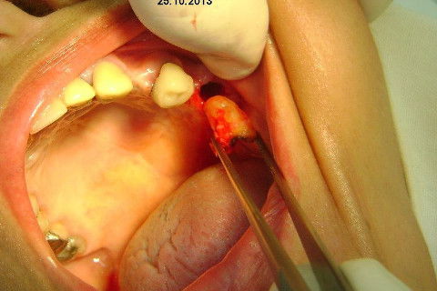 Regeneração Óssea Guiada com Osso Autógeno + Xenógeno + Tela de Titânio