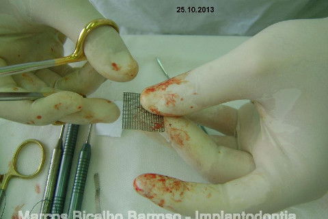 Regeneração Óssea Guiada com Osso Autógeno + Xenógeno + Tela de Titânio