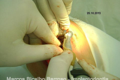 Regeneração Óssea Guiada com Osso Autógeno + Xenógeno + Tela de Titânio