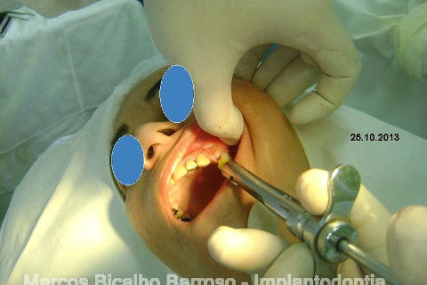 Regeneração Óssea Guiada com Osso Autógeno + Xenógeno + Tela de Titânio