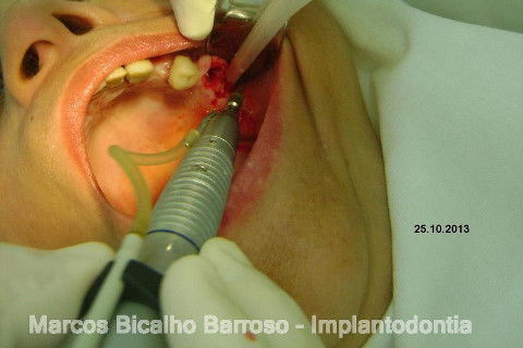 Regeneração Óssea Guiada com Osso Autógeno + Xenógeno + Tela de Titânio