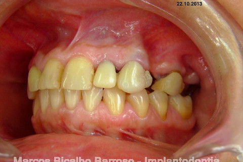 Regeneração Óssea Guiada com Osso Autógeno + Xenógeno + Tela de Titânio