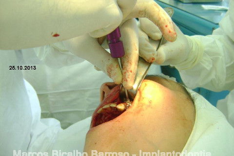 Regeneração Óssea Guiada com Osso Autógeno + Xenógeno + Tela de Titânio