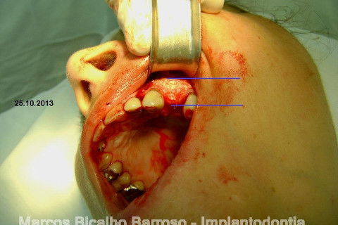 Regeneração Óssea Guiada com Osso Autógeno + Xenógeno + Tela de Titânio