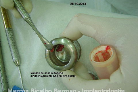 Regeneração Óssea Guiada com Osso Autógeno + Xenógeno + Tela de Titânio