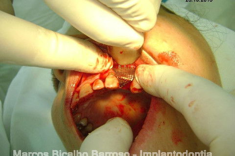 Regeneração Óssea Guiada com Osso Autógeno + Xenógeno + Tela de Titânio