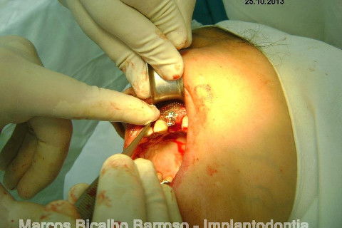 Regeneração Óssea Guiada com Osso Autógeno + Xenógeno + Tela de Titânio