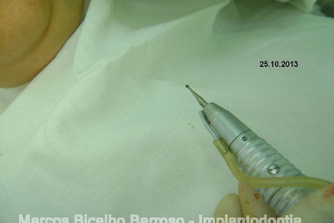 Regeneração Óssea Guiada com Osso Autógeno + Xenógeno + Tela de Titânio