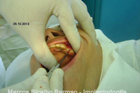 Regeneração Óssea Guiada com Osso Autógeno + Xenógeno + Tela de Titânio