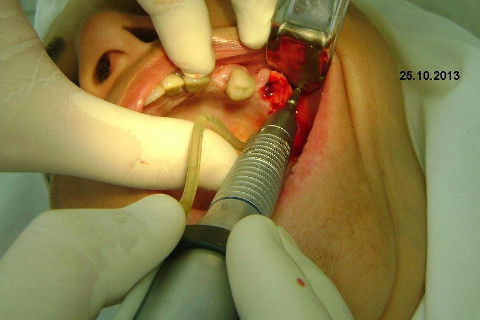 Regeneração Óssea Guiada com Osso Autógeno + Xenógeno + Tela de Titânio