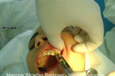 Regeneração Óssea Guiada com Osso Autógeno + Xenógeno + Tela de Titânio