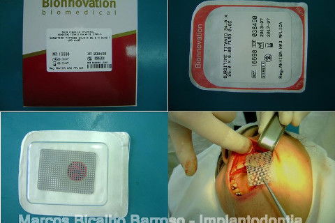 Regeneração Óssea Guiada com Osso Autógeno + Xenógeno + Tela de Titânio