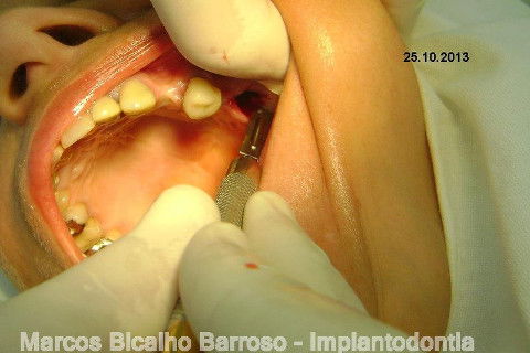 Regeneração Óssea Guiada com Osso Autógeno + Xenógeno + Tela de Titânio