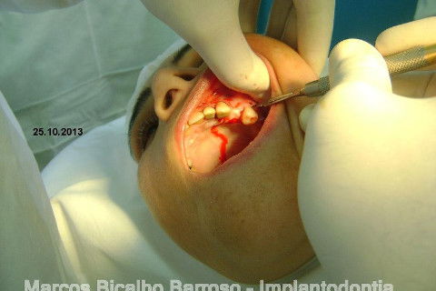 Regeneração Óssea Guiada com Osso Autógeno + Xenógeno + Tela de Titânio