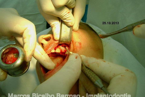 Regeneração Óssea Guiada com Osso Autógeno + Xenógeno + Tela de Titânio