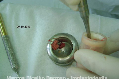 Regeneração Óssea Guiada com Osso Autógeno + Xenógeno + Tela de Titânio