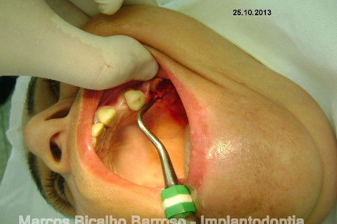 Regeneração Óssea Guiada com Osso Autógeno + Xenógeno + Tela de Titânio