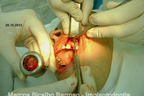 Regeneração Óssea Guiada com Osso Autógeno + Xenógeno + Tela de Titânio