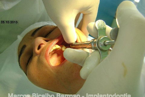 Regeneração Óssea Guiada com Osso Autógeno + Xenógeno + Tela de Titânio