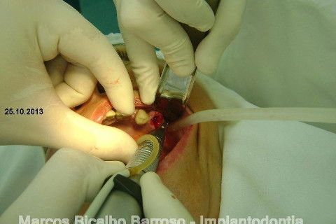 Regeneração Óssea Guiada com Osso Autógeno + Xenógeno + Tela de Titânio