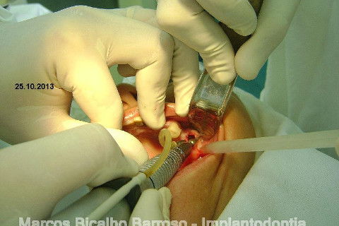 Regeneração Óssea Guiada com Osso Autógeno + Xenógeno + Tela de Titânio