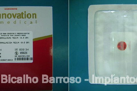 Regeneração Óssea Guiada com Osso Autógeno + Xenógeno + Tela de Titânio
