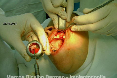 Regeneração Óssea Guiada com Osso Autógeno + Xenógeno + Tela de Titânio