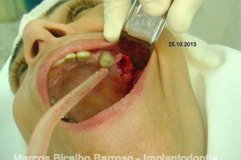 Regeneração Óssea Guiada com Osso Autógeno + Xenógeno + Tela de Titânio