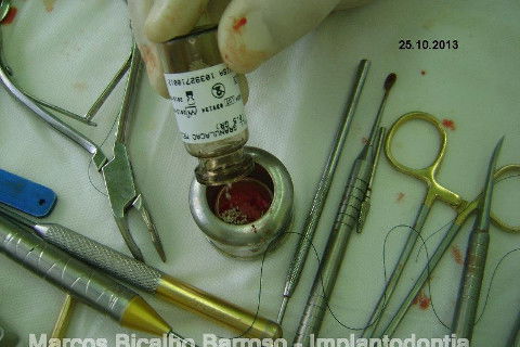 Regeneração Óssea Guiada com Osso Autógeno + Xenógeno + Tela de Titânio