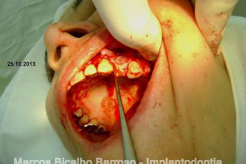 Regeneração Óssea Guiada com Osso Autógeno + Xenógeno + Tela de Titânio