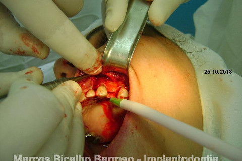 Regeneração Óssea Guiada com Osso Autógeno + Xenógeno + Tela de Titânio