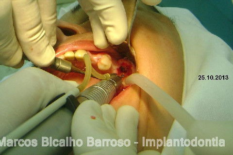 Regeneração Óssea Guiada com Osso Autógeno + Xenógeno + Tela de Titânio