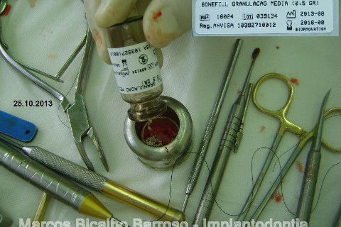 Regeneração Óssea Guiada com Osso Autógeno + Xenógeno + Tela de Titânio