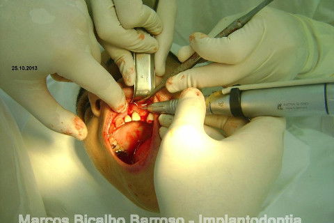 Regeneração Óssea Guiada com Osso Autógeno + Xenógeno + Tela de Titânio