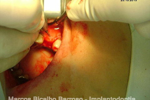 Regeneração Óssea Guiada com Osso Autógeno + Xenógeno + Tela de Titânio