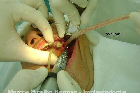 Regeneração Óssea Guiada com Osso Autógeno + Xenógeno + Tela de Titânio