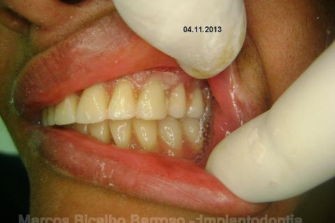 Fase Protética da Reabilitação em Maxila Atrófica